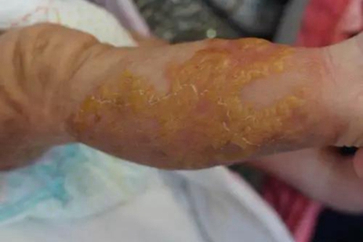 色素失调症小腿黄痂图