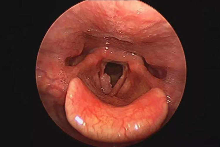 喉部鳞状细胞癌图 喉部鳞状细胞癌图