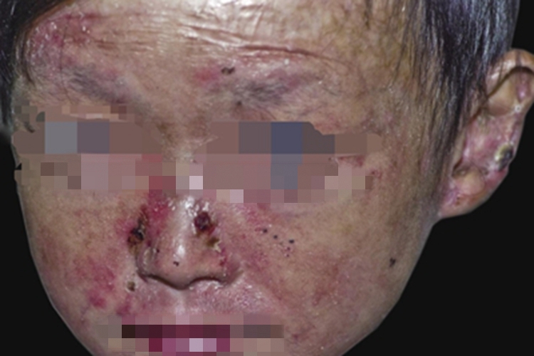 大疱性表皮松解症面部结痂图 大疱性表皮松解症面部结痂图