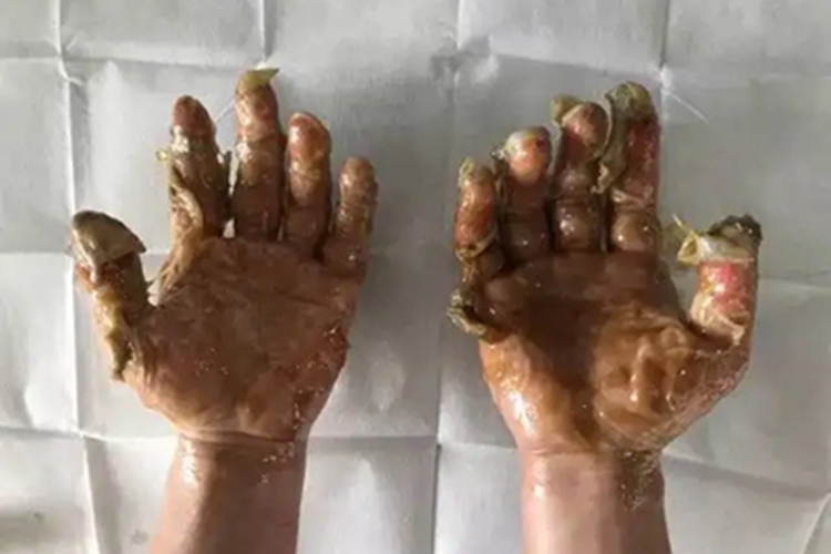 深Ⅱ度烧伤手部症状图