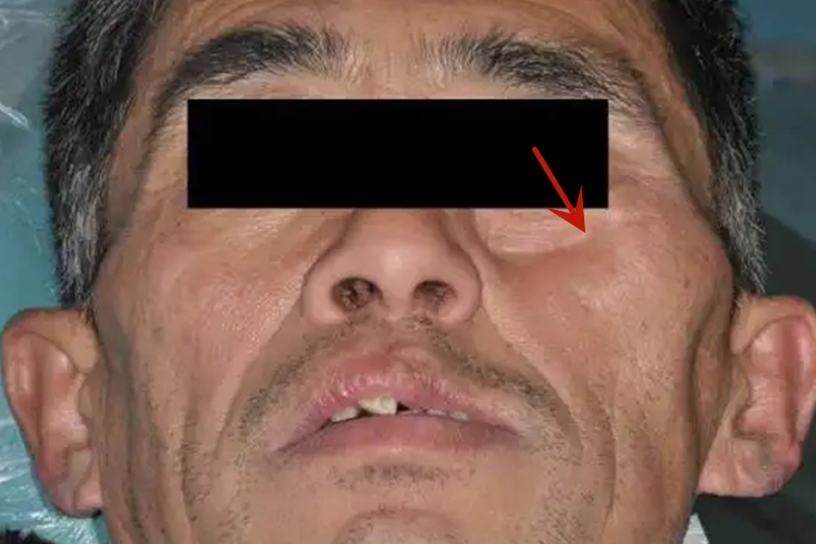 上颌骨切除术术后恢复图