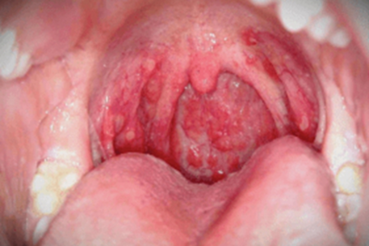脓血型猩红热咽部症状图