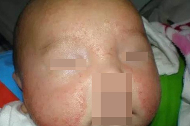 急性湿疹面部大片红斑图