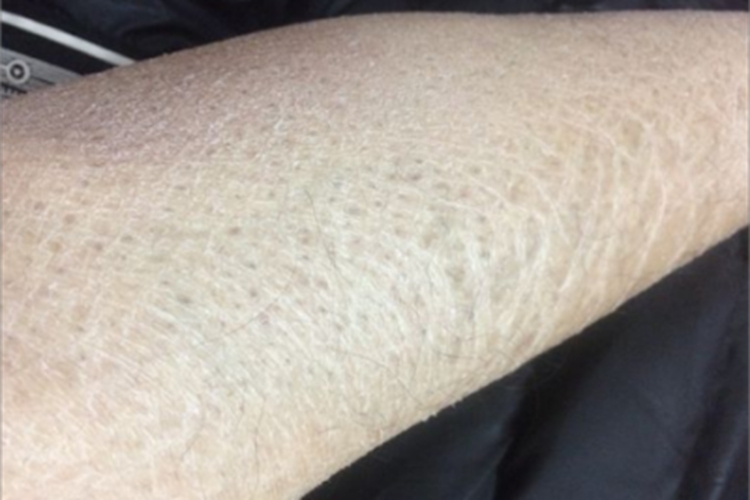 慢性维生素A过多症小腿裂纹图