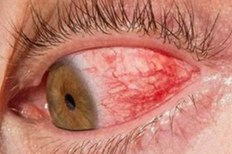 细菌性结膜炎结膜血丝图