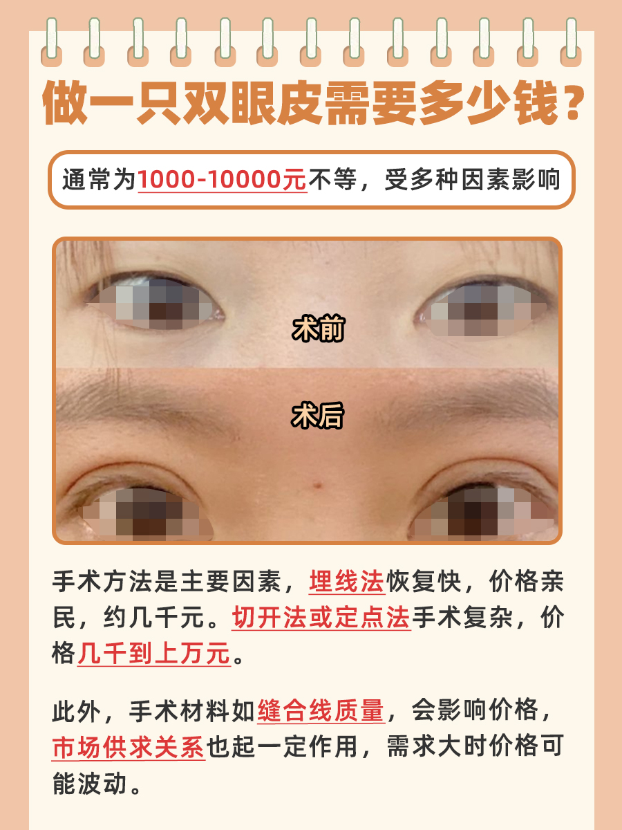 做一只双眼皮手术需要多少钱?这篇告诉你!