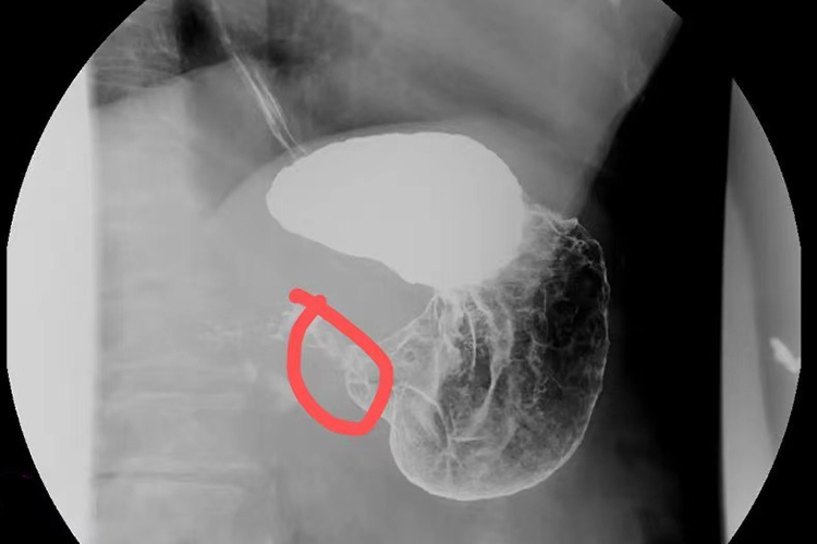 胃溃疡造影图 胃溃疡造影图