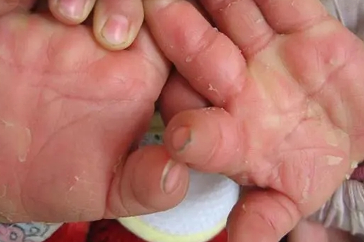 弥漫性掌跖角化病图