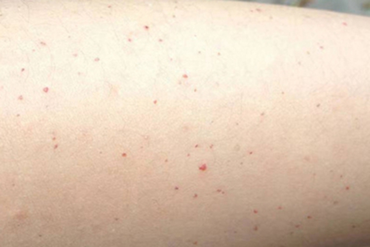 肝硬化大腿红点图