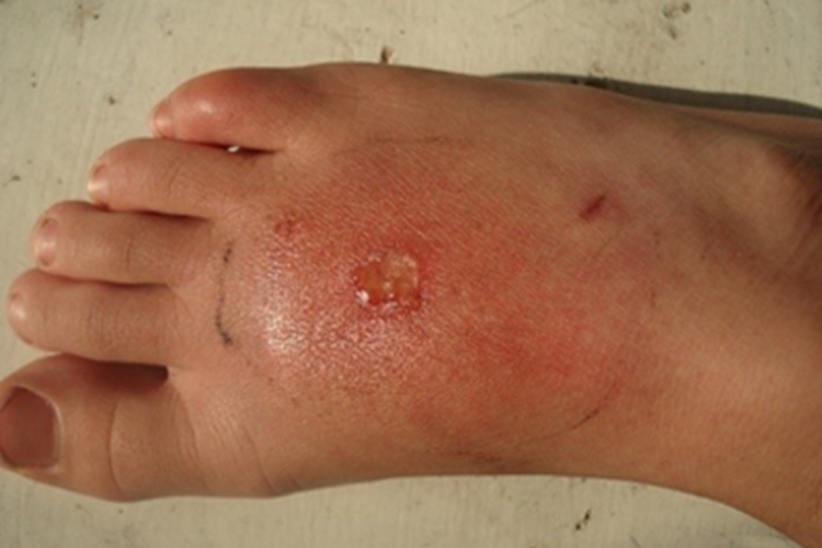 蜂蛰伤脚背红肿水疱图 蜂蛰伤脚背红肿水疱图