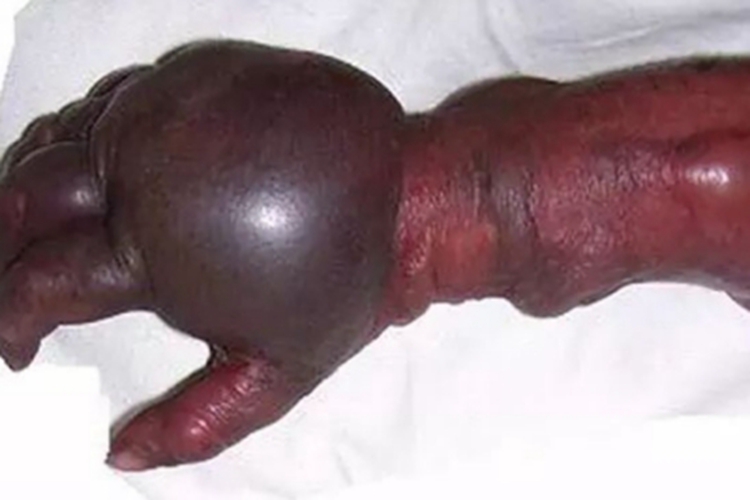气性坏疽手背大水疱图