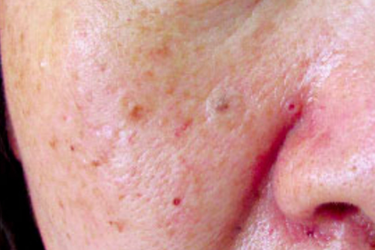 基底样毛囊错构瘤面部丘疹图