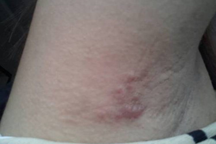 水痘腋窝长了几个疙瘩图