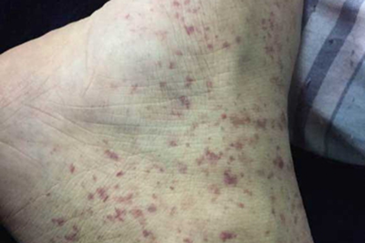 过敏性紫癜脚踝症状图