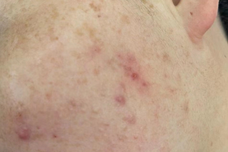 痤疮左脸有几个红疙瘩图