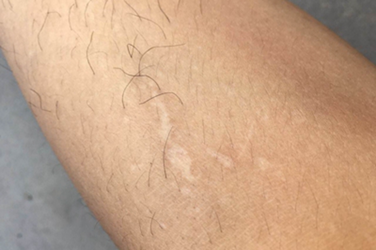 三色白癜风腿上有白点图