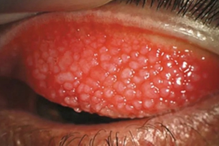 单纯疱疹性结膜炎症状图 单纯疱疹性结膜炎症状图