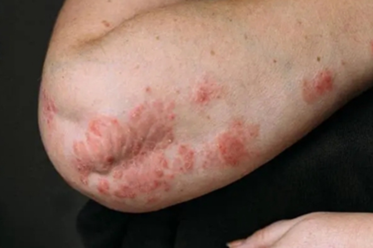 扁平苔藓样角化病胳膊症状图 扁平苔藓样角化病胳膊症状图