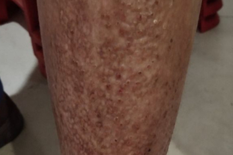 苔藓样淀粉样变病结痂图 苔藓样淀粉样变病结痂图