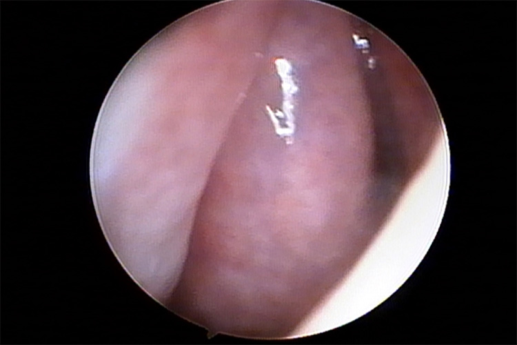 鼻甲肥大有肿物图