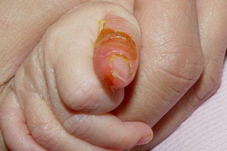 脓疱疮手指脱皮图