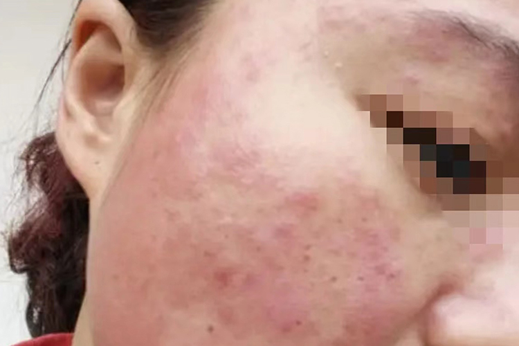 中度化妆品过敏图 中度化妆品过敏图