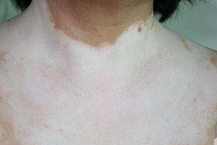 泛发型白癜风前颈症状图