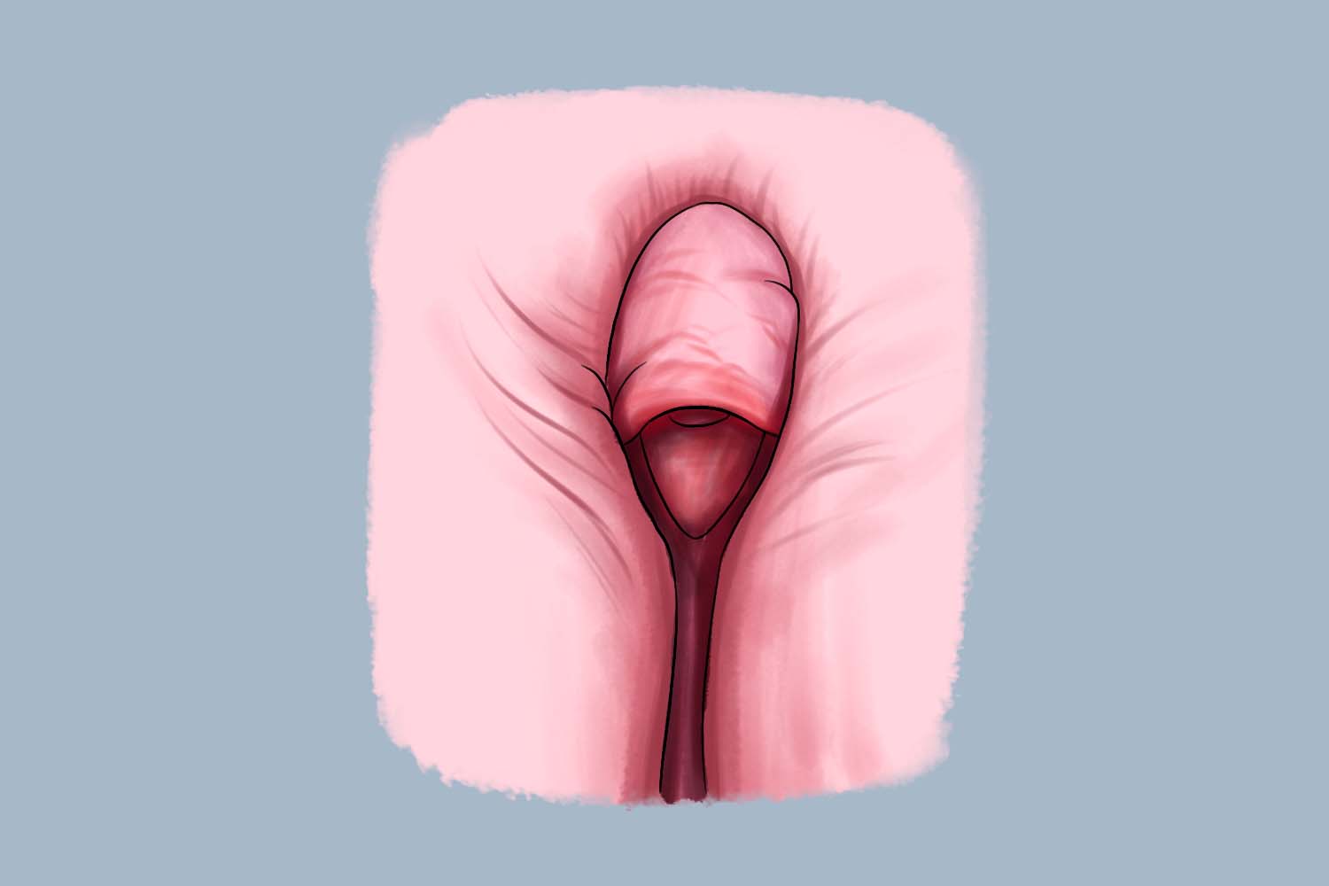 阴蒂肥大图 阴蒂肥大图