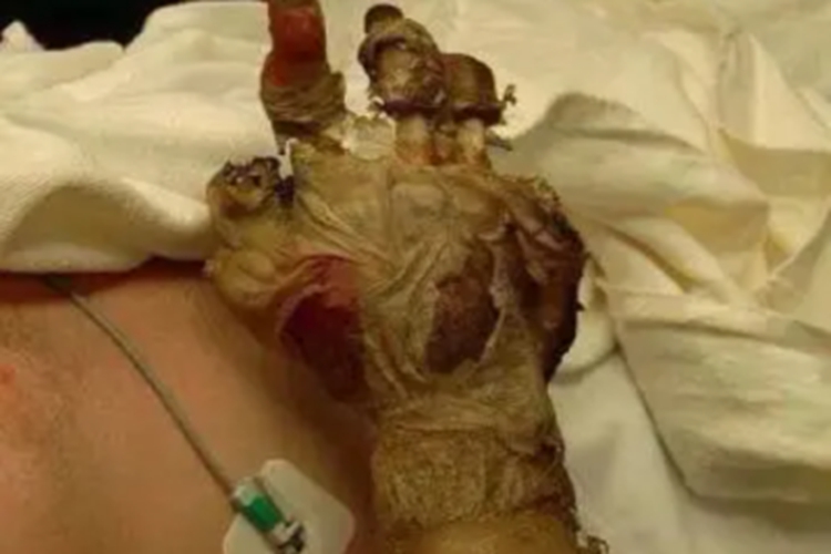 电烧伤手部缺损图