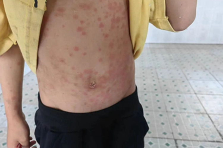 虫咬皮炎腹部红斑图