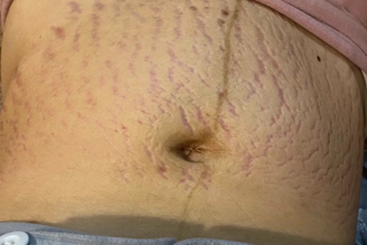 萎缩纹肚子有好多红色纹图