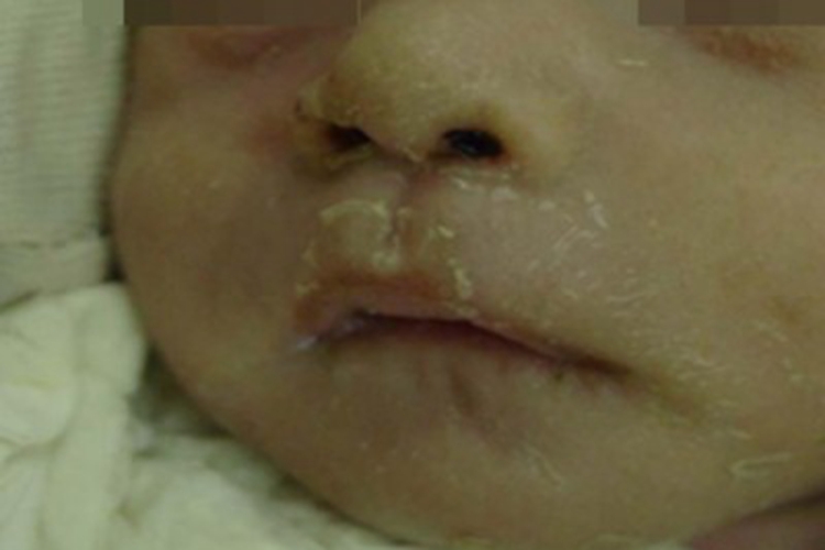 颌面部梅毒口周症状图 颌面部梅毒口周症状图