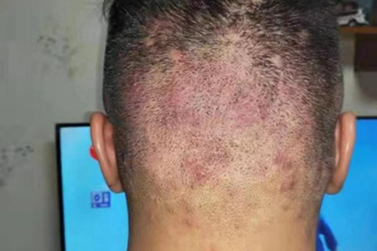 马拉色菌毛囊炎后脑勺疙瘩图