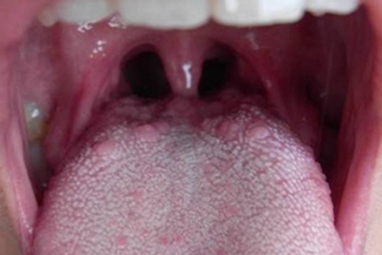 口面部肉芽肿病图