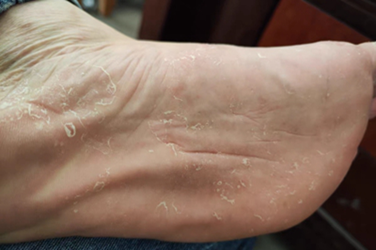 水疱型足癣脚底有脱皮图