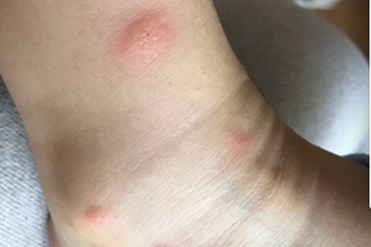 蚋叮咬引起的皮肤反应脚踝丘疹图