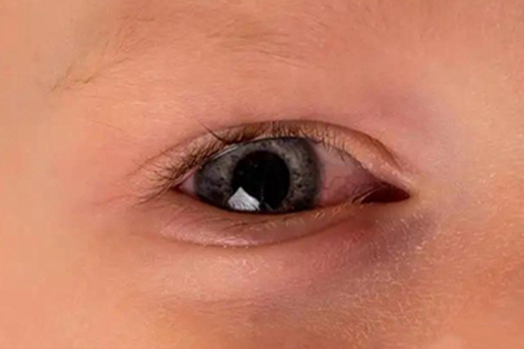 儿童结膜炎初期眼睛红肿图