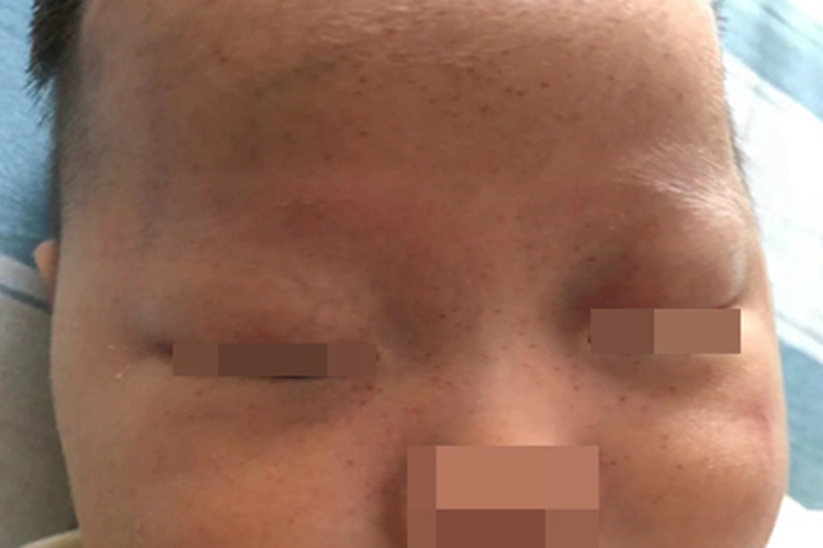 先天性风疹综合征面部症状图