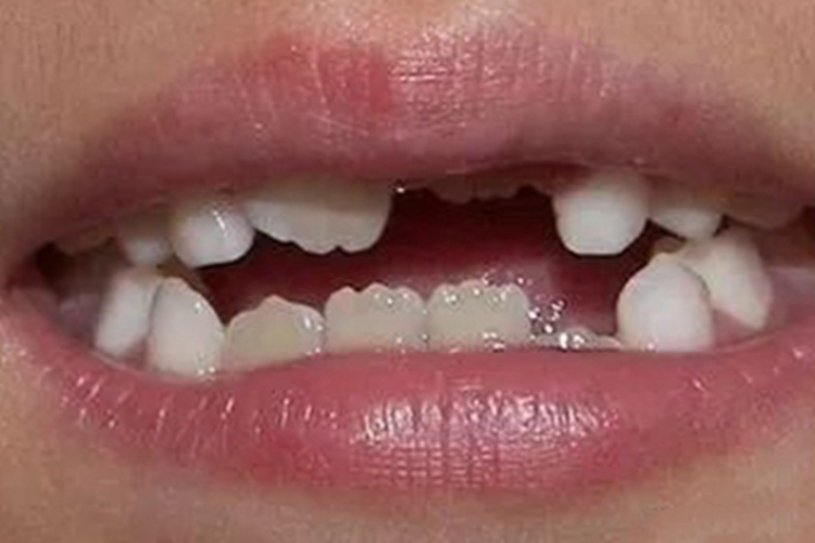 色素失调症畸形图