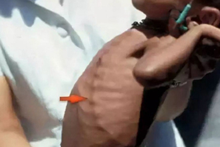 维生素D依赖性佝偻病症状图 维生素D依赖性佝偻病症状图