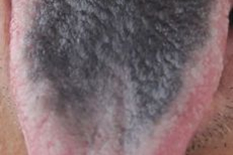 灰黑苔图 灰黑苔图