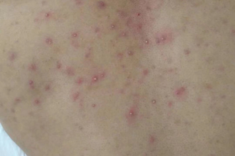 毛囊炎背部脓疱图 毛囊炎背部脓疱图