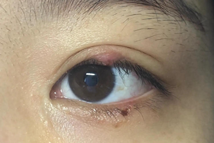 上眼皮长了个小疙瘩是怎么回事