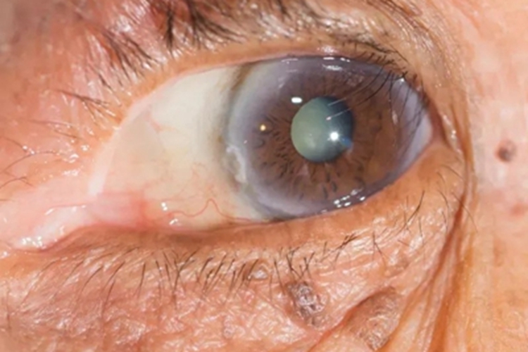 年龄相关性白内障症状图