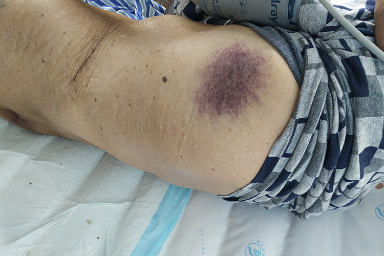 白血病症状图片