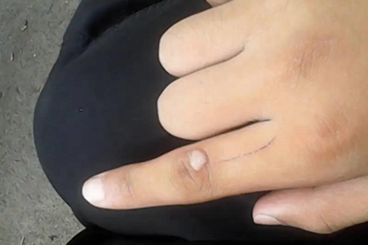 寻常疣手指上有灰褐色硬包图 寻常疣手指上有灰褐色硬包图