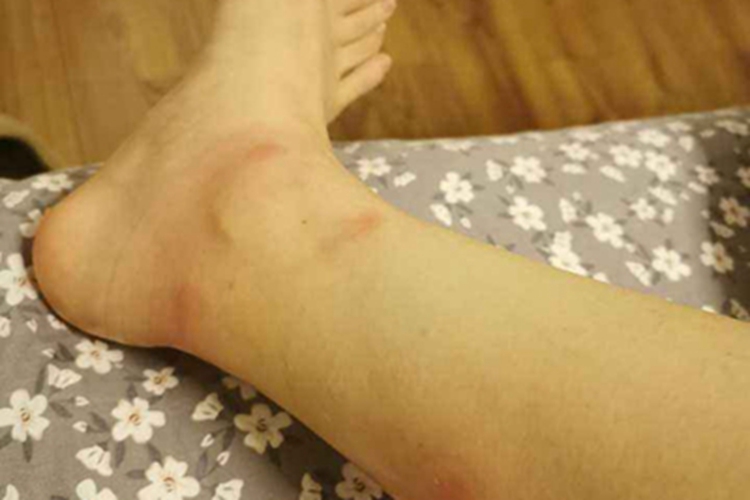 丘疹性荨麻疹脚踝症状图 丘疹性荨麻疹脚踝症状图