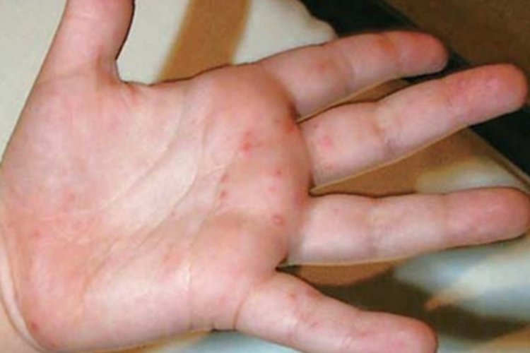 手足口病手上起小疙瘩图