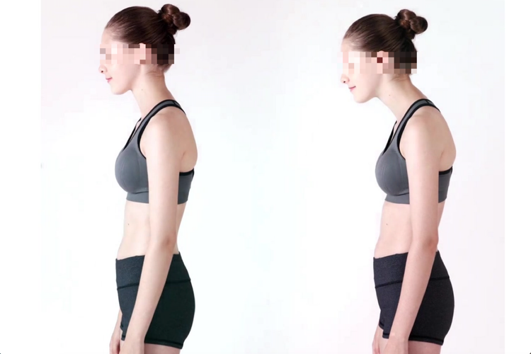 驼背和不驼背对比图