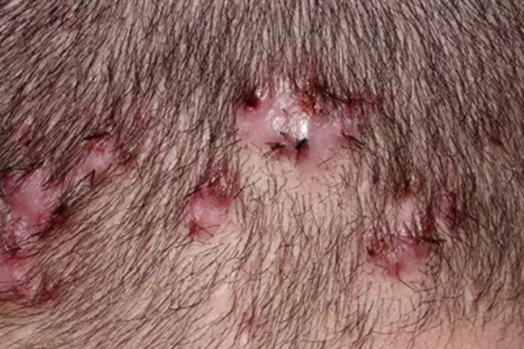 秃发性毛囊炎结痂图 秃发性毛囊炎结痂图